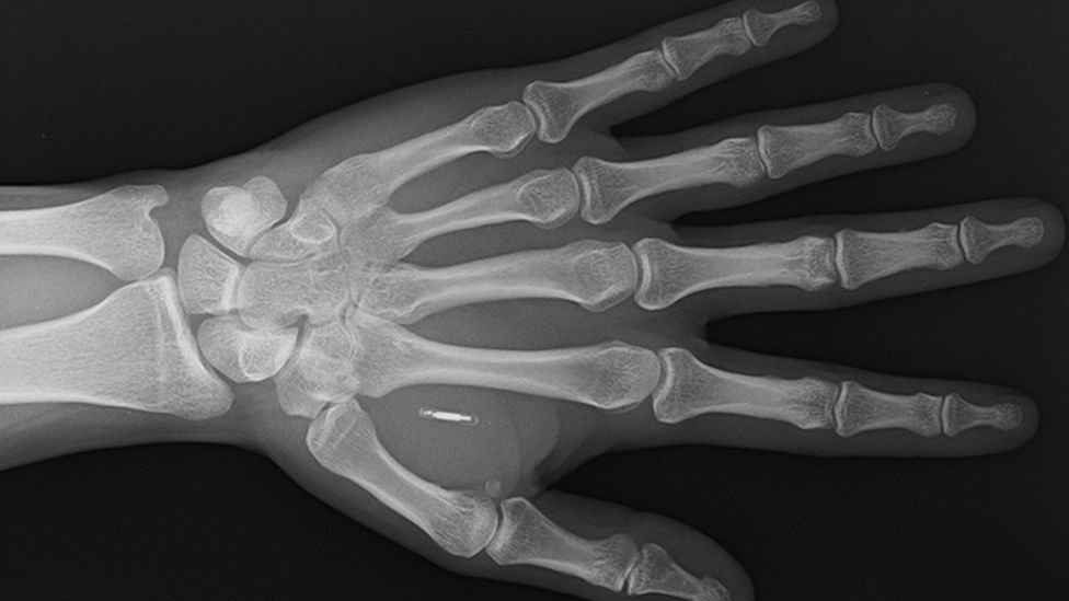 植入晶片後手的X光照
